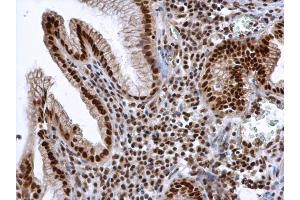 IHC-P Image ALY antibody detects ALY protein at nucleus in human esophageal cancer by immunohistochemical analysis. (THO Complex 4 抗体)