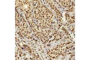 Immunohistochemical analysis of XRCC4 staining in human breast cancer formalin fixed paraffin embedded tissue section. (XRCC4 抗体)