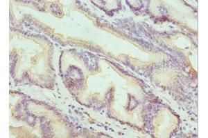 Immunohistochemistry of paraffin-embedded human prostate cancer using ABIN7157199 at dilution of 1:100 (Kallikrein 10 抗体  (AA 35-276))