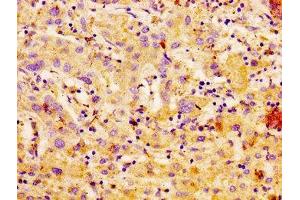 IHC image of ABIN7146723 diluted at 1:100 and staining in paraffin-embedded human liver cancer performed on a Leica BondTM system. (CA4 抗体  (AA 75-200))