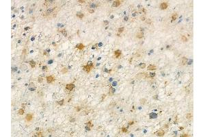 ABIN7093972 and ABIN7098016 at 1/100 staining human astrocytoma by IHC-P. (Retinoic Acid Receptor gamma 抗体  (N-Term))