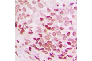 Immunohistochemical analysis of NEIL3 staining in human breast cancer formalin fixed paraffin embedded tissue section.