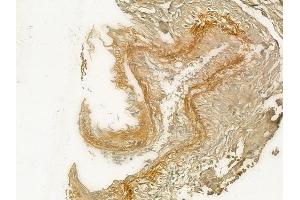 ABIN6258413 and ABIN6274622 at 1/100 staining human lung adenocarcinoma by IHC-P.