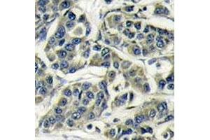 IHC analysis of FFPE human breast carcinoma stained with S6K antibody