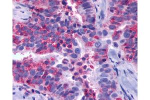 Anti-GPR137B antibody IHC of human Ovary, Carcinoma. (GPR137B 抗体  (Cytoplasmic Domain))