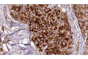 ABIN6272677 at 1/100 staining Human liver cancer tissue by IHC-P. (Calcitonin Receptor 抗体  (N-Term))