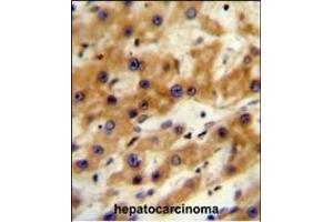 GAGE13 Antibody (N-term) (ABIN654525 and ABIN2844247) immunohistochemistry analysis in formalin fixed and paraffin embedded human hepatocarcinoma followed by peroxidase conjugation of the secondary antibody and DAB staining. (G Antigen 13 抗体  (N-Term))