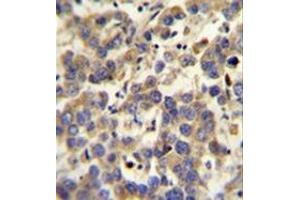 Immunohistochemistry analysis in formalin fixed and paraffin embedded human testis carcinoma reacted with  LYPD4 Antibody (Center) followed which was peroxidase conjugated to the secondary antibody and followed by DAB staining. (LYPD4 抗体  (Middle Region))