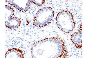 Formalin-fixed, paraffin-embedded human Prostate Carcinoma stained with p40 Rabbit Polyclonal Antibody. (p63 抗体  (AA 5-17))