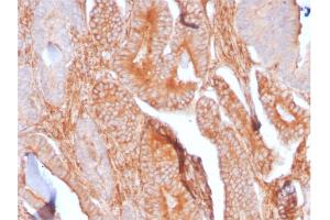 Formalin-fixed, paraffin-embedded human Prostate Carcinoma stained with CD81 Rabbit Recombinant Monoclonal Antibody (C81/2885R). (Recombinant CD81 抗体)