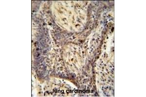 RC1 antibody (C-term) (ABIN654964 and ABIN2844603) immunohistochemistry analysis in formalin fixed and paraffin embedded human lung carcinoma followed by peroxidase conjugation of the secondary antibody and DAB staining. (PPRC1 抗体  (C-Term))