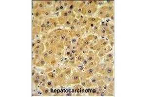 F10 Antibody (C-term) (ABIN390688 and ABIN2840978) IHC analysis in formalin fixed and paraffin embedded human hepatocarcinoma followed by peroxidase conjugation of the secondary antibody and DAB staining.