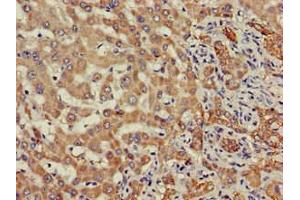 Immunohistochemistry of paraffin-embedded human liver cancer using ABIN7171195 at dilution of 1:100 (SDC4 抗体  (AA 19-145))