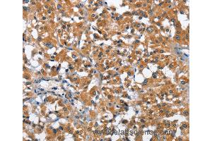 Immunohistochemistry of Human thyroid cancer using ARMCX2 Polyclonal Antibody at dilution of 1:40 (ARMCX2 抗体)