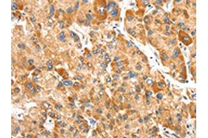 The image on the left is immunohistochemistry of paraffin-embedded Human liver cancer tissue using ABIN7192438(SLC24A6 Antibody) at dilution 1/20, on the right is treated with synthetic peptide. (SLC24A6 抗体)