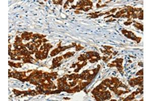 The image on the left is immunohistochemistry of paraffin-embedded Human colon cancer tissue using ABIN7128251(ADCY3 Antibody) at dilution 1/50, on the right is treated with fusion protein.