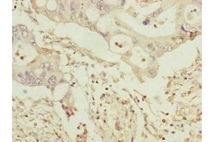 Immunohistochemistry of paraffin-embedded human pancreatic cancer using ABIN7159917 at dilution of 1:100 (TOMM34 抗体  (AA 1-309))