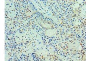 Immunohistochemistry of paraffin-embedded human breast cancer using ABIN7150969 at dilution of 1:100 (PIAS3 抗体  (AA 399-628))