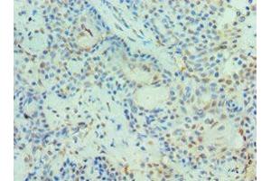 Immunohistochemistry of paraffin-embedded human breast cancer using ABIN7150969 at dilution of 1:100