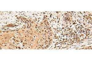 Immunohistochemistry of paraffin-embedded Human esophagus cancer tissue using PTH1R Polyclonal Antibody at dilution of 1:65(x200) (PTH1R 抗体)