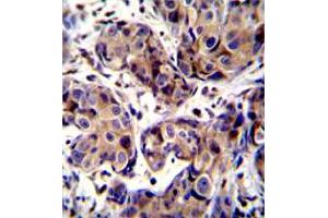 Immunohistochemistry (Formalin/PFA-fixed paraffin-embedded sections) of human breast cancer tissue withMAGEA3 polyclonal antibody . (MAGEA3 抗体  (AA 283-314))