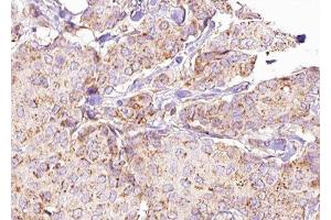ABIN6276290 at 1/100 staining Human breast cancer tissue by IHC-P. (ATG5 抗体  (C-Term))