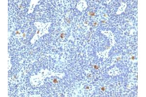 Formalin-fixed, paraffin-embedded human Cervix stained with HPV-16 Mouse Monoclonal Antibody (HPV16/1295). (HPV16 抗体)