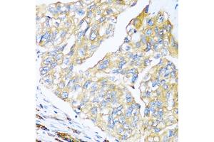 Immunohistochemistry of paraffin-embedded human prostate cancer using MANF antibody (ABIN6291535) at dilution of 1:100 (40x lens). (MANF 抗体)