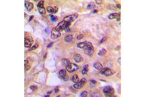 Immunohistochemical analysis of PKA C alpha/beta staining in human breast cancer formalin fixed paraffin embedded tissue section. (PKA/C alpha/beta (N-Term) 抗体)