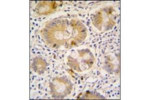 Formalin-Fixed, Paraffin-Embedded human colon carcinoma tissue reacted with Autophagy APG16L antibody (C-term), which was peroxidase-conjugated to the secondary antibody, followed by DAB staining.