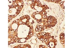 IHC-P: Src antibody testing of human intestinal cancer tissue (Src 抗体  (AA 2-368))