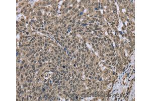 Immunohistochemistry of Human breast cancer using DCTN4 Polyclonal Antibody at dilution of 1:30 (Dynactin 4 抗体)