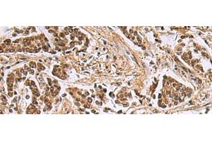 Immunohistochemistry of paraffin-embedded Human breast cancer tissue using DNA2 Polyclonal Antibody at dilution of 1:40(x200) (DNA2 抗体)