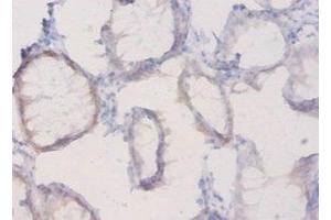 Immunohistochemistry of paraffin-embedded human colon cancer using ABIN7163695 at dilution of 1:20 (Plexin A1 抗体  (AA 32-296))
