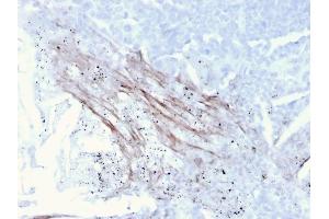 Formalin-fixed, paraffin-embedded human Lung Carcinoma stained with Tenascin C Mouse Recombinant Monoclonal Antibody (TNC/3635).