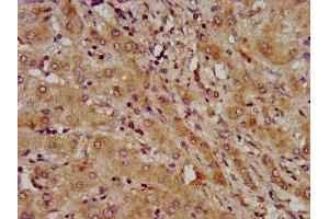 IHC image of ABIN7158792 diluted at 1:600 and staining in paraffin-embedded human liver cancer performed on a Leica BondTM system. (LAPTM4B 抗体  (AA 174-226))