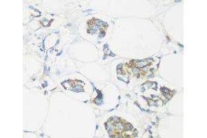 Immunohistochemistry of paraffin-embedded Human mammary cancer using NMT1 Polyclonal Antibody at dilution of 1:100 (40x lens). (NMT1 抗体)