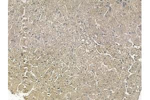 ABIN6256505 and ABIN6267159 at 1/100 staining human hepatocellular carcinoma by IHC-P. (PLK1 抗体  (pThr210))