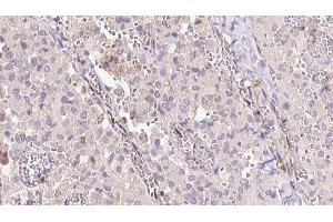 ABIN6273313 at 1/100 staining Human thyroid cancer tissue by IHC-P. (SAT1 抗体  (C-Term))