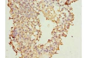 Immunohistochemistry of paraffin-embedded human breast cancer using ABIN7145623 at dilution of 1:100 (NUDT2 抗体  (AA 1-147))