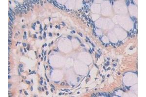 Detection of ZBP1 in Human Colorectal cancer Tissue using Polyclonal Antibody to Z-DNA Binding Protein 1 (ZBP1) (ZBP1 抗体  (AA 10-167))
