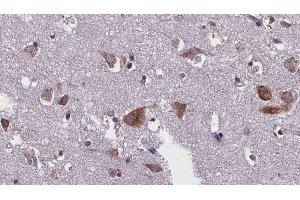 ABIN6276299 at 1/100 staining Human brain cancer tissue by IHC-P. (Caspase 10 抗体)