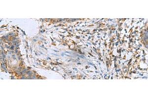 Immunohistochemistry of paraffin-embedded Human esophagus cancer tissue using RPL10A Polyclonal Antibody at dilution of 1:50(x200) (RPL10A 抗体)