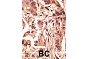 Formalin-fixed and paraffin-embedded human cancer tissue reacted with the primary antibody, which was peroxidase-conjugated to the secondary antibody, followed by DAB staining. (SIRT6 抗体  (C-Term))