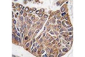 IHC analysis of FFPE human lung carcinoma tissue stained with AKT2 antibody (AKT2 抗体  (AA 416-444))