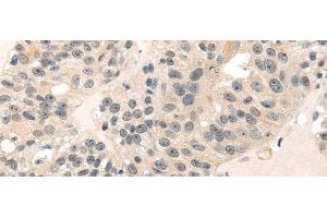Immunohistochemistry of paraffin-embedded Human breast cancer using MED28 Polyclonal Antibody at dilution of 1/30 (MED28 抗体)