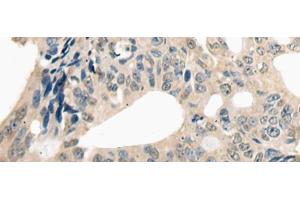 Immunohistochemistry of paraffin-embedded Human colorectal cancer tissue using ETV4 Polyclonal Antibody at dilution of 1:25(x200) (ETV4 抗体)