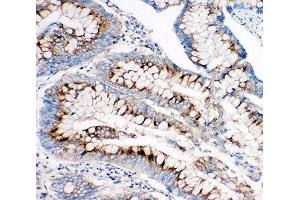 IHC-P: IGF2R antibody testing of human intestine cancer tissue (IGF2R 抗体  (C-Term))