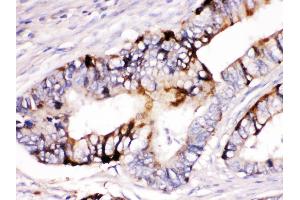 ZP2 was detected in paraffin-embedded sections of human intestinal cancer tissues using rabbit anti- ZP2 Antigen Affinity purified polyclonal antibody at 1 μg/mL. (ZP2 抗体  (N-Term))