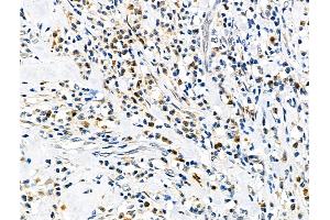 ABIN6258629 and ABIN6275742 at 1/100 staining Human esophageal cancer by IHC-P.